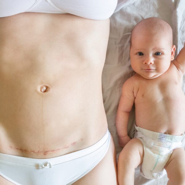 10 cuidados esenciales para la mamá tras una cesárea